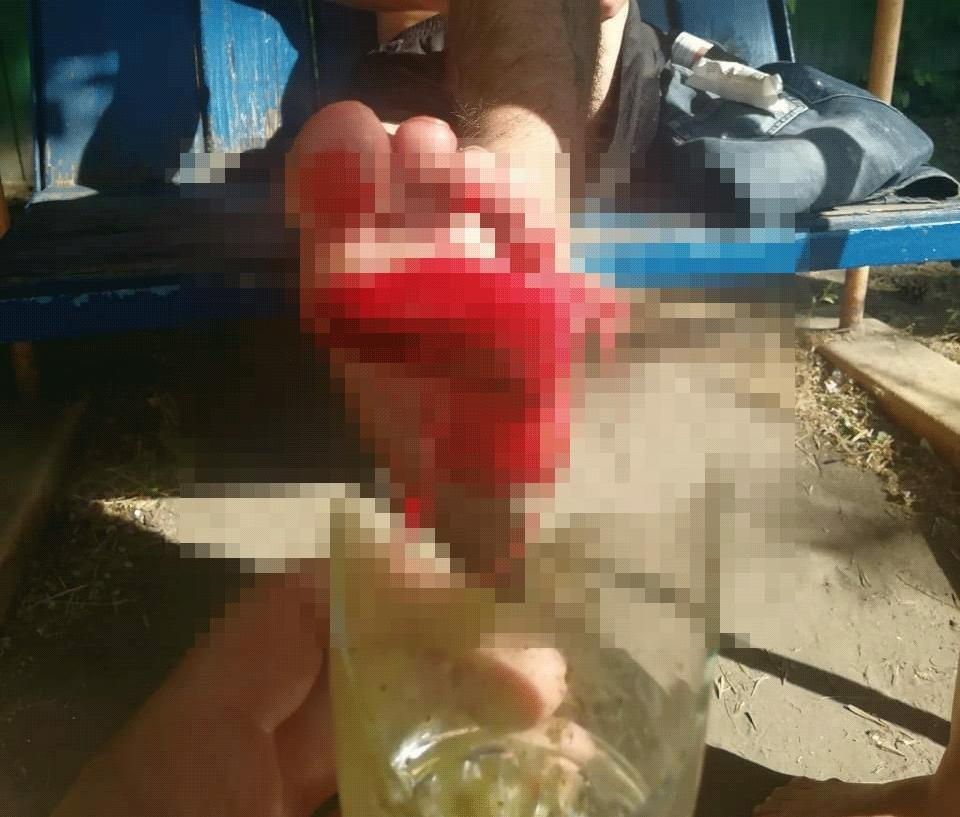 Отдых на базе «Волна» закончился для волгодонца торчащим в ноге стаканом Отдых на базе «Волна» закончился для волгодонца торчащим в ноге стаканом