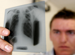 Два ребенка заразились туберкулезом с начала года в Волгодонске